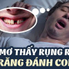 [Giải mã giấc mơ]: Nằm mơ thấy rụng răng đánh đề con gì? 